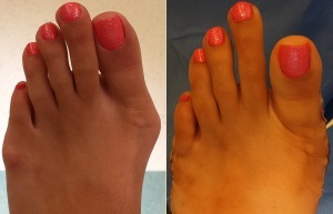 Bunion Pictures Before and After Surgery