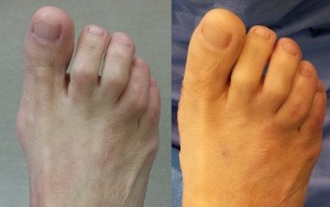 Minimally Invasive Bunion Surgery Pictures Before and After Operation