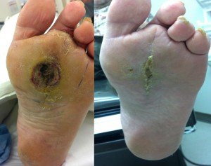 Healed Diabetic Foot Ulcer/Wound after surgery