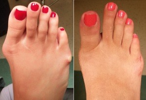 Bunion Picture Pre Op and Post Op 3 months after surgery