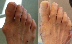 Before and After Bunion Surgery Pictures
