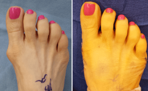 Bunion surgery pictures before and after
