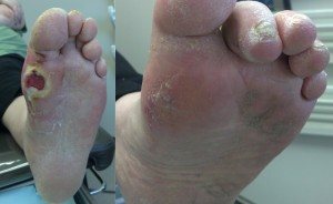 Closed foot diabetic ulcer after a simple surgery: before and after
