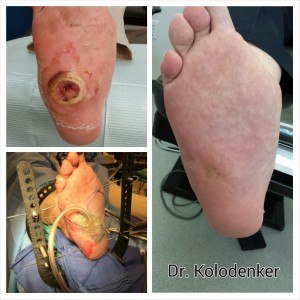 Closed ulceration due to Charcot foot after surgery