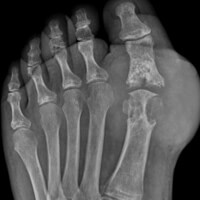 End Stage Gouty Arthritis of the Big Toe Joint