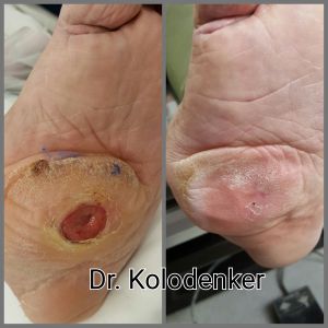 Limb Preservation | Why do Diabetic Foot Ulcers form?